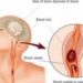 Waspadai Serangan Stroke Tiba-tiba di Usia Produktif