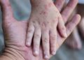 Virus Cacar Monyet Terdeteksi di Inggris