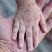 Virus Cacar Monyet Terdeteksi di Inggris