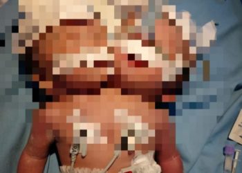 Bayi Kembar Siam di Pariaman Dirujuk ke RSUP Padang