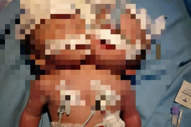 Bayi Kembar Siam di Pariaman Dirujuk ke RSUP Padang