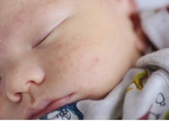 4 Cara Mengatasi Jerawat Pada Bayi dan Penyebabnya