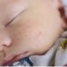 4 Cara Mengatasi Jerawat Pada Bayi dan Penyebabnya
