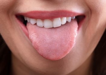 Lidah Melepuh Karena Makanan Panas, Ini 7 Pengobatan Alaminya