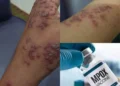 Wabah Mpox (Cacar Monyet) Merebak! Berikut Pentingnya Langkah Pencegahan