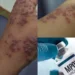 Wabah Mpox (Cacar Monyet) Merebak! Berikut Pentingnya Langkah Pencegahan